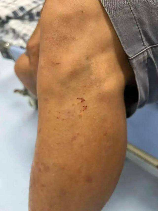 廣東62歲阿叔網(wǎng)魚網(wǎng)到2條眼鏡蛇<strong></p>
<p>宏鑫機(jī)械設(shè)備有限公司
</strong>，被咬傷后當(dāng)場打死，并打包提進(jìn)醫(yī)院:宏鑫機(jī)械設(shè)備有限公司
