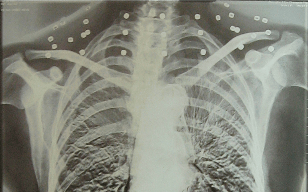 “老先生<strong></p>
<p>宏鑫機械設備有限公司
</strong>，您把項鏈取下來再做CT”:宏鑫機械設備有限公司
