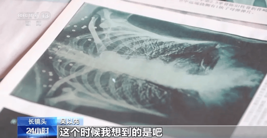 “老先生<strong></p>
<p>宏鑫機械設備有限公司
</strong>，您把項鏈取下來再做CT”:宏鑫機械設備有限公司
