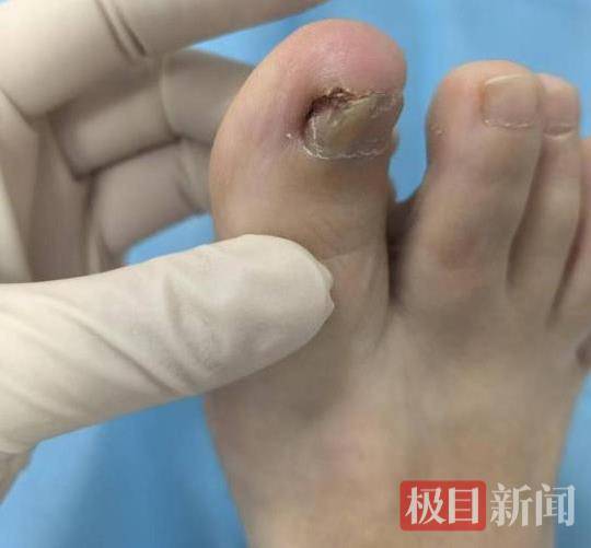 六旬女子被甲溝炎折磨了三年<strong></p>
<p>宏鑫機(jī)械設(shè)備有限公司
</strong>，專家30分鐘手術(shù)解難題:宏鑫機(jī)械設(shè)備有限公司
